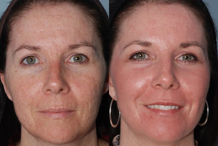 antes y después del rejuvenecimiento de la piel con hardware