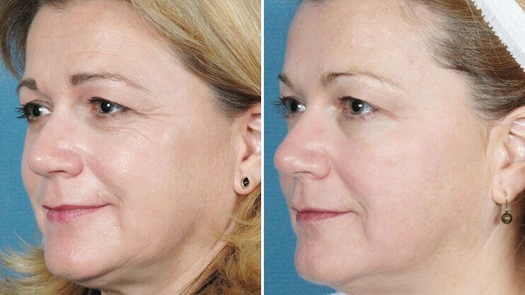 fotos antes y después del rejuvenecimiento de la piel con hardware