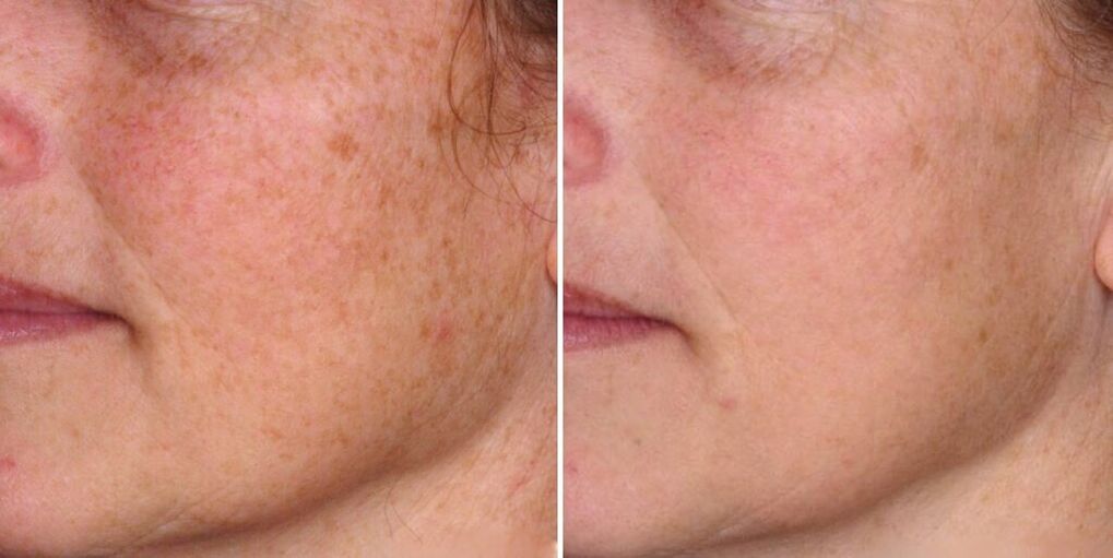 piel de la cara antes y después del rejuvenecimiento